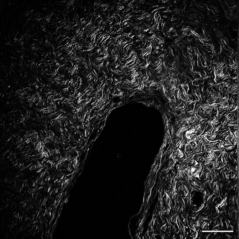 microscopy of collagen fibers in the tumor microenvironment surrounding an early stage breast cancer