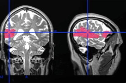 Magnetic resonance image of a patient’s brain after stroke.