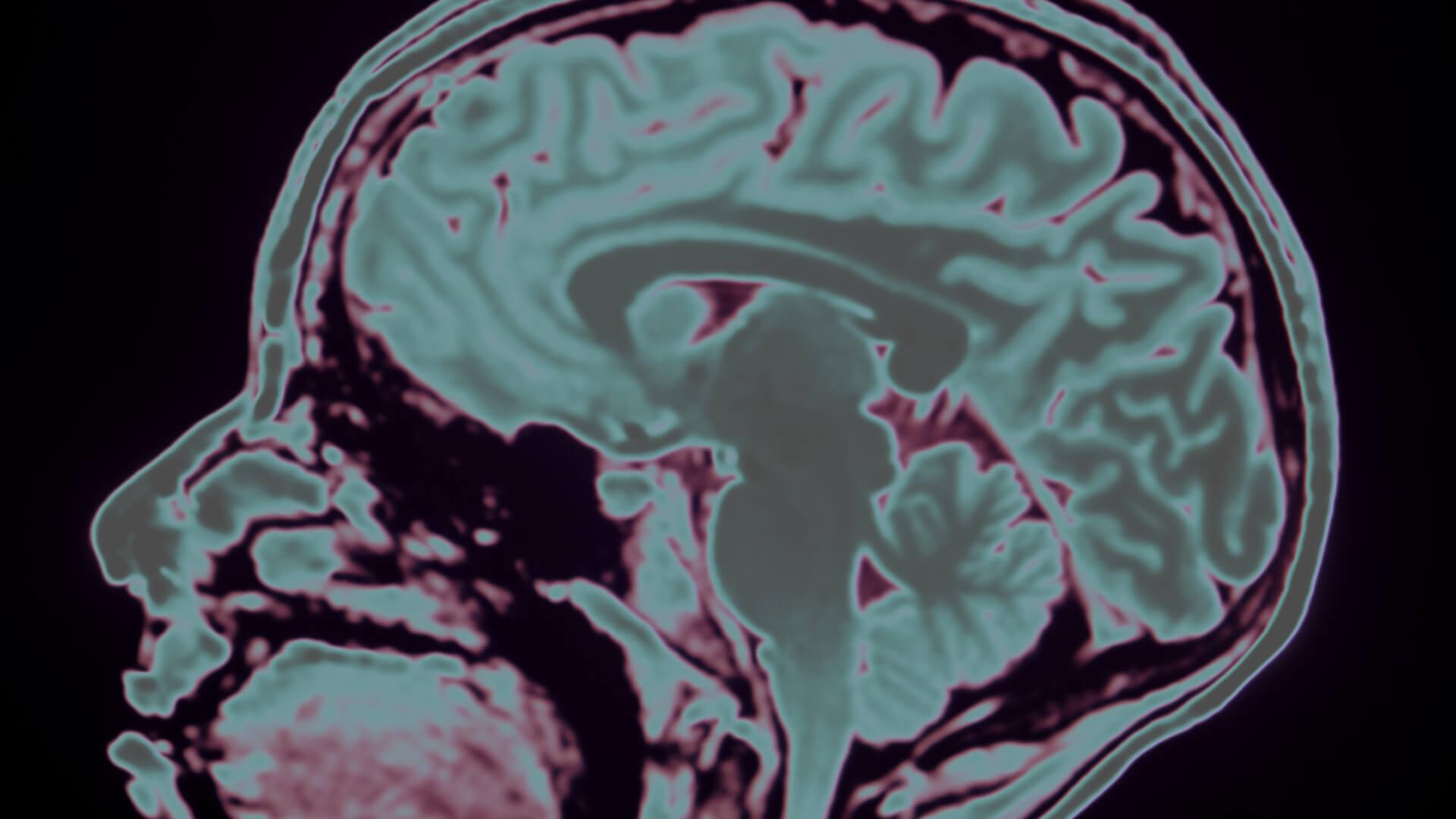 brain scan