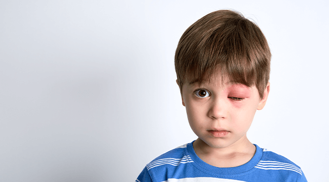 young child with swollen eye